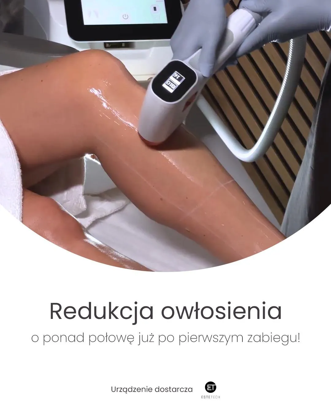 Efekt redukcji niedoskonałości skóry po zabiegu